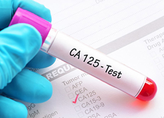 Blood collection tube labelled CA 125 test on a tumor-marker request form