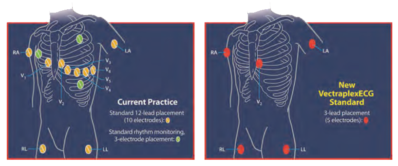 Diagram comparing current 12-lead electrode placement with the five-electrode Vectraplex ECG placement